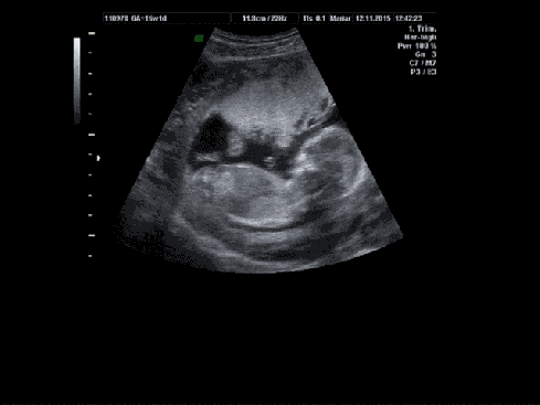 baby at 20 weeks